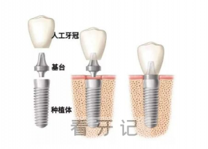 烤瓷牙种植牙哪个好、区别、如何选择