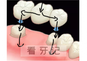 烤瓷牙种植牙哪个好、区别、如何选择