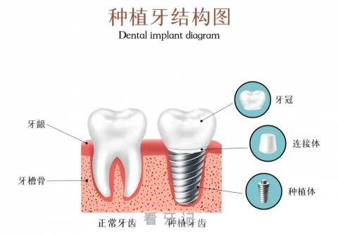种植牙结构图解高清照片图片