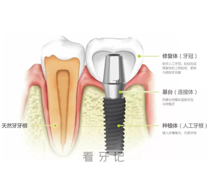 种植牙结构图解高清照片图片