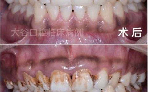 杭州大谷口腔洗牙记