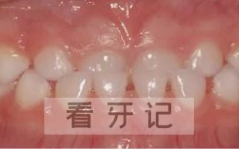 乳牙反颌地包天照片对比图