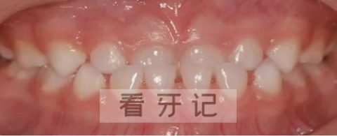 乳牙反颌地包天照片对比图
