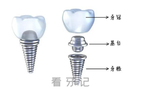 上海市民看牙记种植牙为什么这么贵