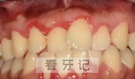 洗牙抛光前后对比图片差太大了上海牙医张文鑫