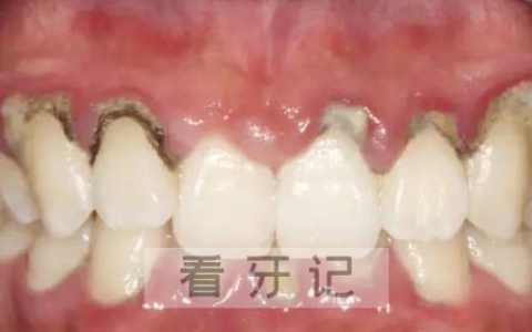 洗牙抛光前后对比图片差太大了上海牙医张文鑫