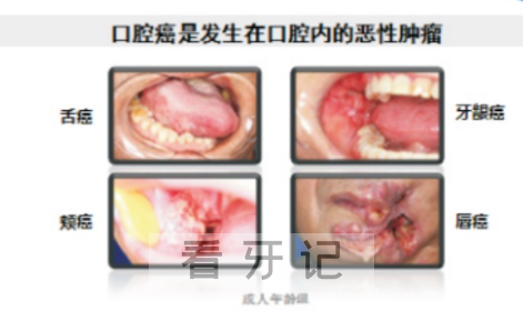 口腔癌早期症状有哪些具体表现附图片