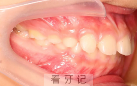青苗儿童口腔看牙记儿童矫正牙齿是贩卖焦虑吗