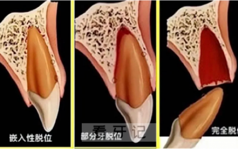 牙齿断了怎么办？别怕！意外磕断的牙还能救活