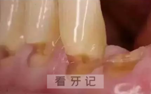 楔状缺损图片实拍照片
