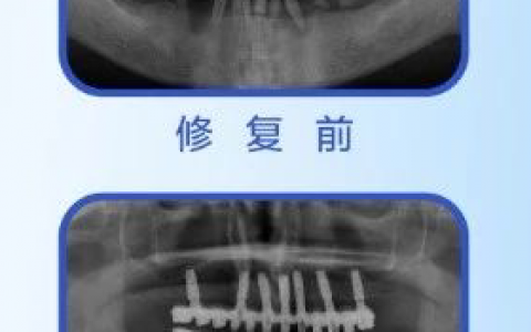 杭州口腔医院湖州分院院长胡其勇种牙记