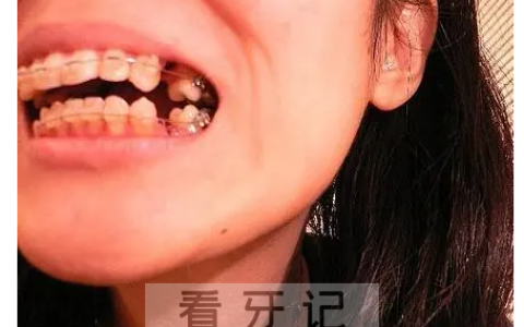 正畸拔4号牙正畸拔5号牙区别