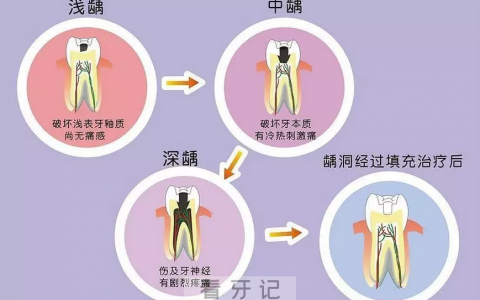 宝宝蛀牙早期图片浅龋照片中度龋照片奶瓶龋照片邻面龋照片