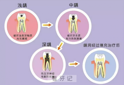 宝宝蛀牙早期图片浅龋照片中度龋照片奶瓶龋照片邻面龋照片