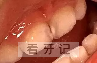 宝宝蛀牙早期图片浅龋照片中度龋照片奶瓶龋照片邻面龋照片