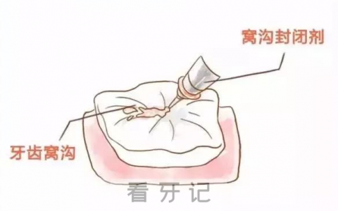 做窝沟封闭疼不疼一颗价位大概多少