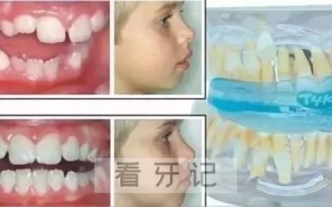 替牙期错颌畸形矫正前后照片对比图