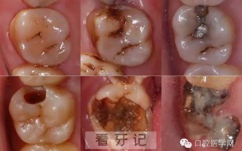 蛀牙龋齿一步步烂牙洞过程真实图片照片