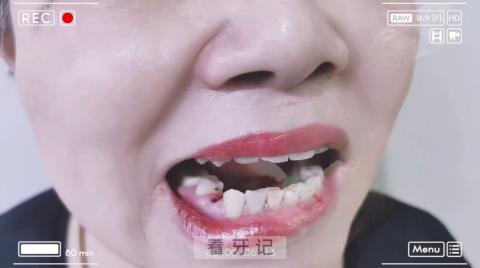 郑州唯美口腔医院64岁阿姨种植牙看牙记