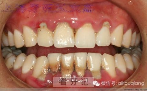 牙周炎洗牙前后对比高清照片