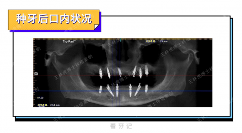 武汉存济口腔医院王林虎全口种植即刻修复看牙记