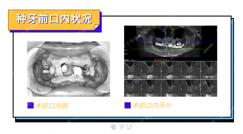 武汉存济口腔医院王林虎全口种植即刻修复看牙记