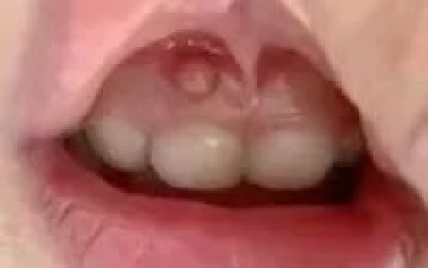 孩子牙龈鼓包照片鼓包了怎么办？