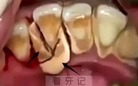攒了10年的牙结石长什么样