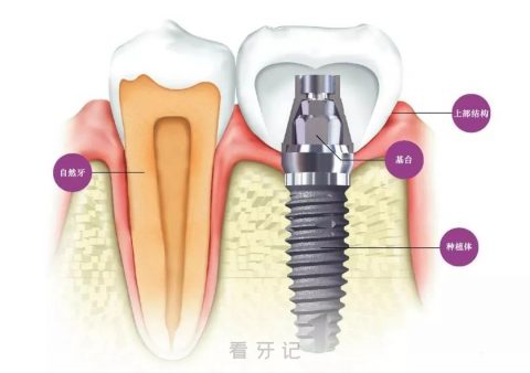 种植牙六大优势