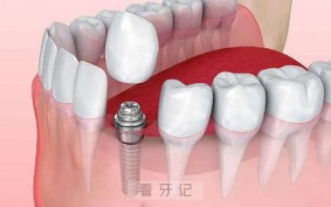 种植牙材料是什么