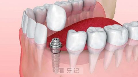 种植牙材料是什么