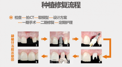 种植牙流程