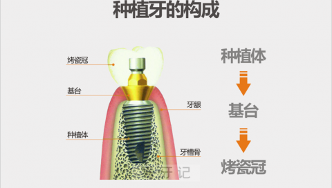 种植牙构成