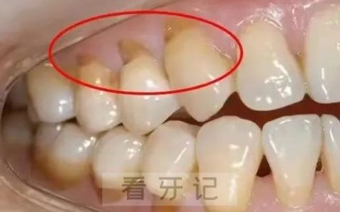楔状缺损图片科普预防
