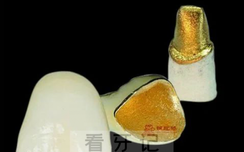 黄金烤瓷牙优缺点