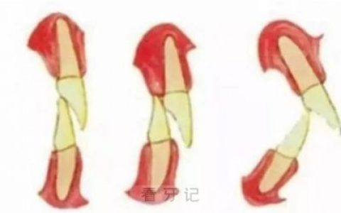 深覆颌深覆盖区别矫正效果对比图