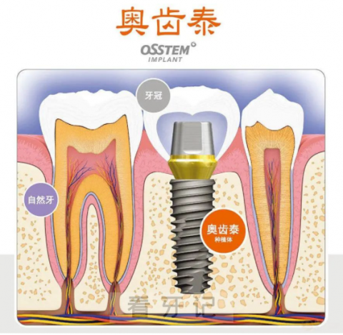 韩国奥齿泰种植系统种植体介绍