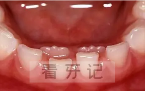 儿童多生牙照片图片