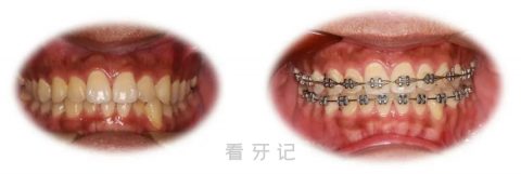 北京口腔医院看牙记