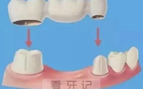 缺牙修复固定桥好不好