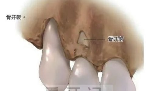 正畸骨开窗骨开裂图片