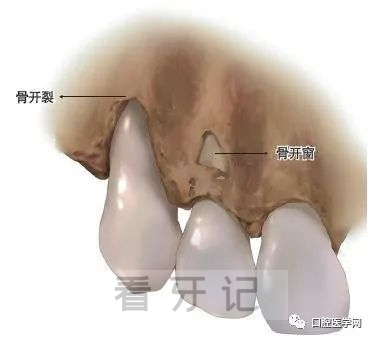 正畸骨开窗骨开裂图片