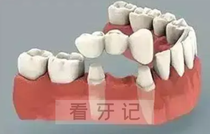 固定义齿修复后注意事项有哪些