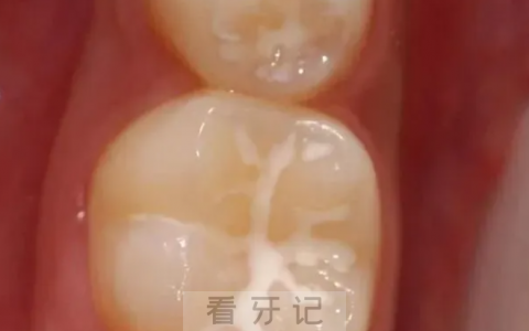 儿童牙齿做完窝沟封闭注意事项