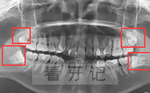上海国之美口腔拔智齿术后提醒