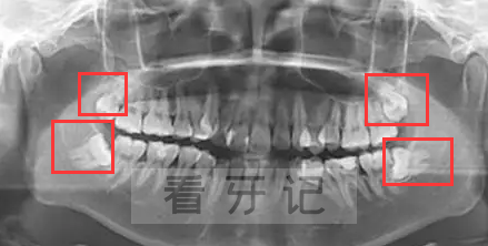 上海国之美口腔拔智齿术后提醒