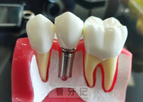 宁波“医保种植牙”单颗种植牙价格3500元封顶