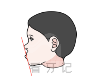 儿童正畸牙齿矫正12岁以前还是以后到底该听谁的