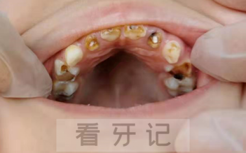 全国最新儿童乳牙龋齿患病率是多少