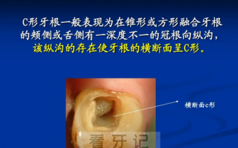 什么是C型根管含图片